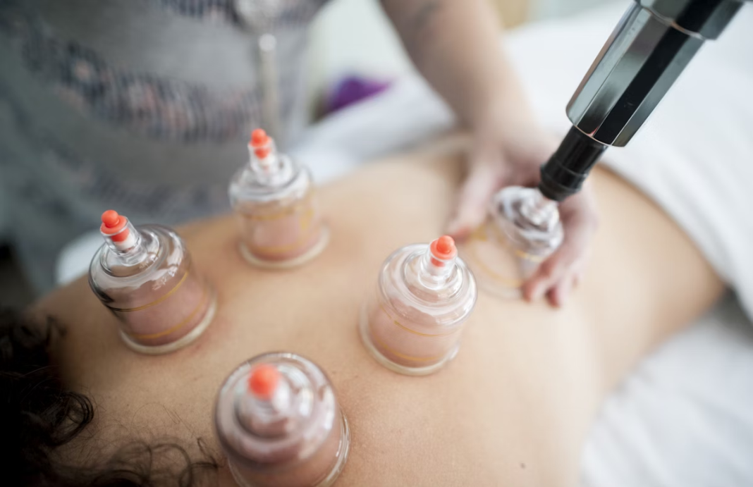 Acupuncture Therapy